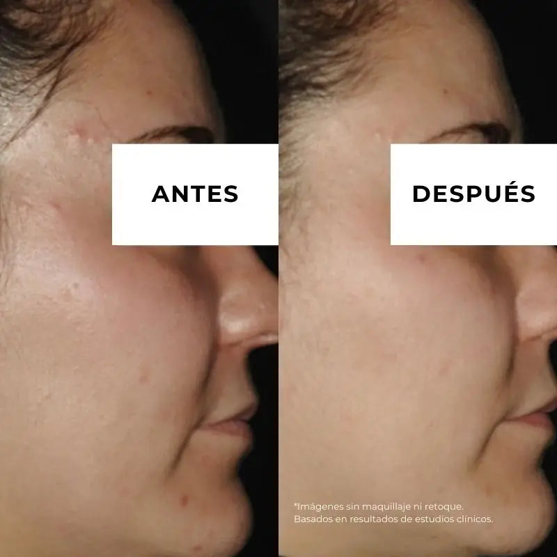 Arganour Crème Anti-Acné Equilibre Visage, 50 Ml