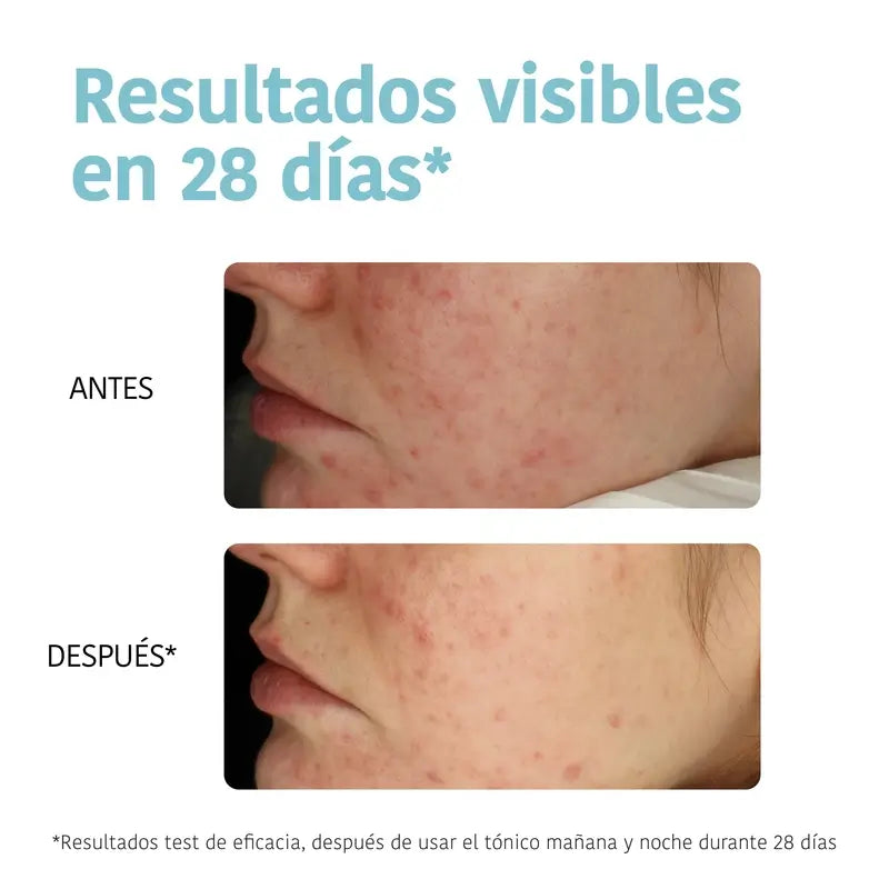 Iroha Nature Disques toniques exfoliants anti-imperfections pour peaux grasses, 50 pièces.
