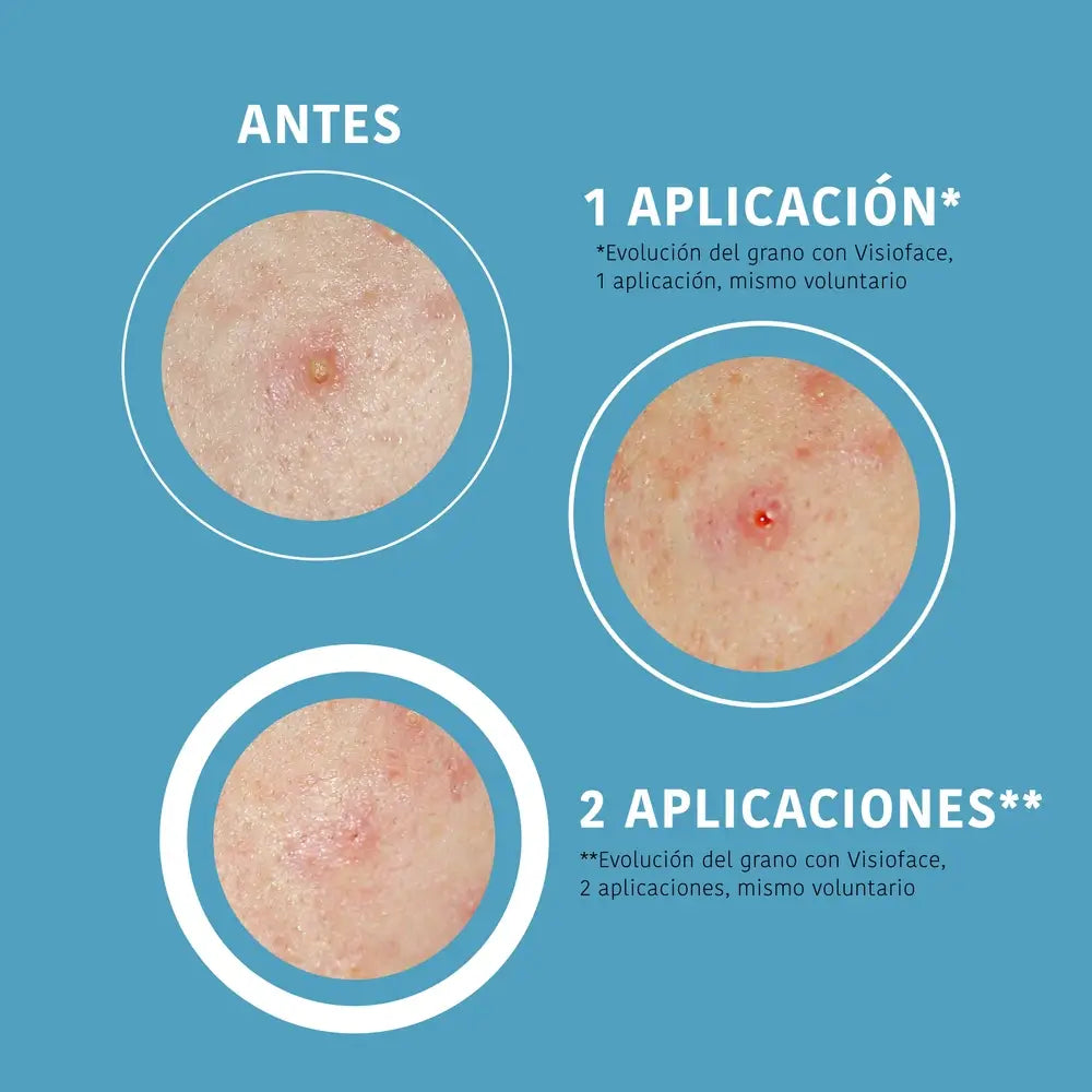 Iroha Nature Sos Pimples Patches - Acide salicylique, 18 pcs.