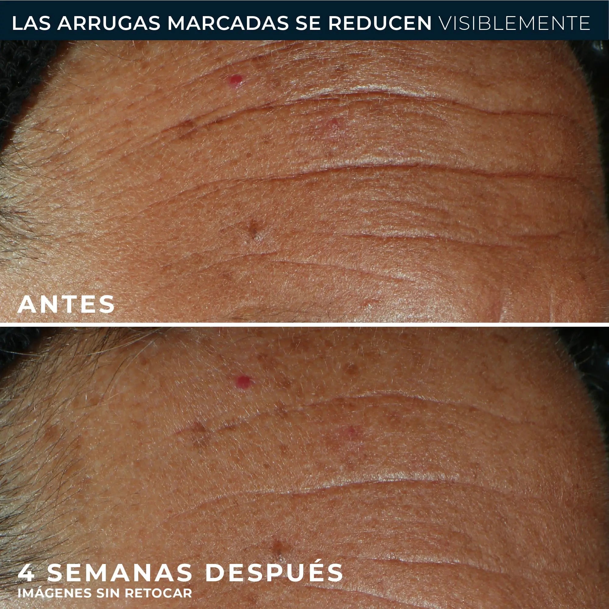 Roc Skincare Iberia Roc® Derm Correxion® Fill + Treat 15Ml